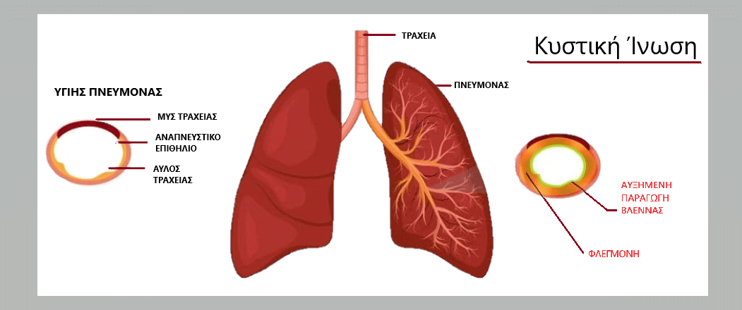 Κυστική Ίνωση